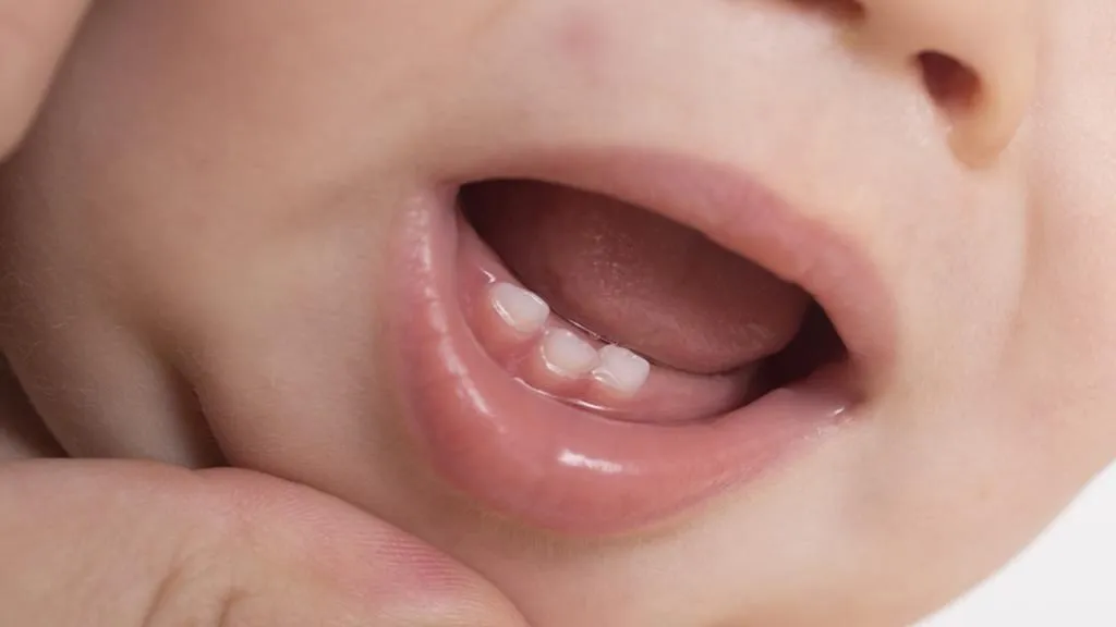 Close-up of a baby's mouth showing new teeth erupting.