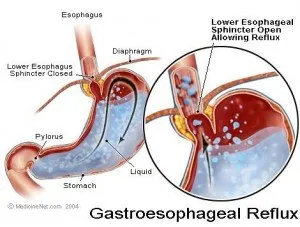 Diagram of an infant's stomach showing how trapped air sits above the oesophageal opening, causing reflux-like vomiting